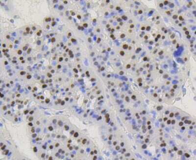 Immunohistochemistry-Paraffin: Cyclin D1 Antibody (SA38-08) [NBP2-67306] - Analysis of paraffin-embedded human liver carcinoma tissue using anti-Cyclin D1 antibody. Counter stained with hematoxylin.