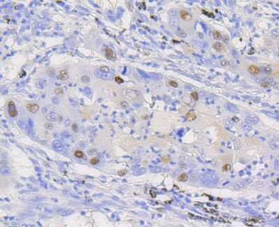 Immunohistochemistry-Paraffin: Cyclin D1 Antibody (SA38-08) [NBP2-67306] - Analysis of paraffin-embedded human lung carcinoma tissue using anti-Cyclin D1 antibody. Counter stained with hematoxylin.