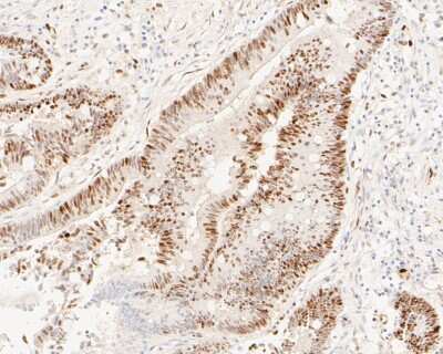 Immunohistochemistry-Paraffin: Cyclin D1 Antibody (SA38-08) [NBP2-67306] - Immunohistochemical analysis of paraffin-embedded human colon carcinoma tissue using anti-Cyclin D1 antibody. The section was pre-treated using heat mediated antigen retrieval with sodium citrate buffer (pH 6.0) for 20 minutes. The tissues were blocked in