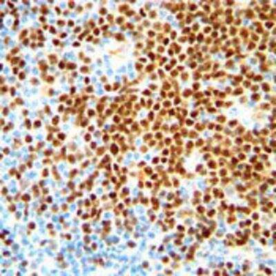 Immunohistochemistry-Paraffin: Cyclin D1 Antibody (SP4) [NB600-584] - Staining of human mantle cell lymphoma stained. Note nuclear staining of tumor cells.