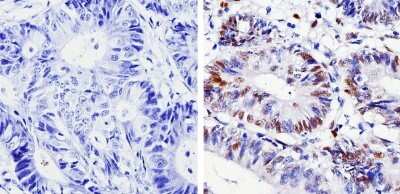 Immunohistochemistry-Paraffin: Cyclin D1 Antibody (SP4) [NB600-584] - Analysis showing staining in the nucleus of human colon carcinoma (right) compared with a negative control in the absence of primary antibody (left).