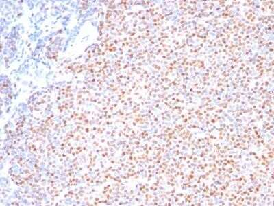 Immunohistochemistry-Paraffin: Cyclin D1 Antibody (SPM587) - IHC-Prediluted [NBP2-44585] - Formalin-paraffin human Mantle Cell Lymphoma stained with Cyclin D1 Ab (Clone SPM587).