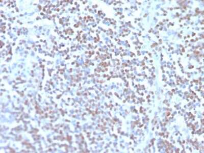 Immunohistochemistry-Paraffin: Cyclin D1 Antibody (rCCND1/4752) - Azide and BSA Free [NBP3-08953] - Formalin-fixed, paraffin-embedded human mantle cell lymphoma stained Cyclin D1 Recombinant Mouse Monoclonal Antibody (rCCND1/4752).