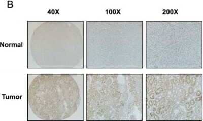 Immunohistochemistry: Cyclin D2 Antibody [NBP2-14460] - Evaluation of Cyclin D2 expression in RCC samples. Immunohistochemistry staining showed a significant decrease of Cyclin D2 protein expression in 43 paired RCC samples in 40X, 100X, 200X magnification. Image collected and cropped by CiteAb from the following publication (//dx.plos.org/10.1371/journal.pone.0161859), licensed under a CC-BY license.