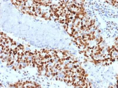 Immunohistochemistry-Paraffin: Cyclin E1 Antibody (CCNE1/2460) [NBP3-07484] - Formalin-fixed, paraffin-embedded human colon carcinoma stained with Cyclin E1 Mouse Monoclonal Antibody (CCNE1/2460).