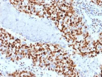 Immunohistochemistry-Paraffin: Cyclin E1 Antibody (CCNE1/2460) [NBP3-08805] - Formalin-fixed, paraffin-embedded human colon carcinoma stained with Cyclin E1 Mouse Monoclonal Antibody (CCNE1/2460).