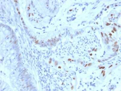Immunohistochemistry-Paraffin: Cyclin E1 Antibody (CCNE1/2460) [NBP3-08805] - Formalin-fixed, paraffin-embedded human colon carcinoma stained with Cyclin E1 Mouse Monoclonal Antibody (CCNE1/2460).