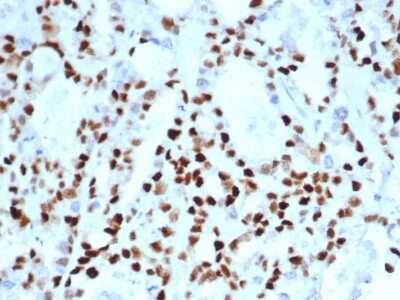Immunohistochemistry-Paraffin: Cyclin E1 Antibody (CCNE1/4935R) - Azide and BSA Free [NBP3-08810] - Formalin-fixed, paraffin-embedded human ovarian carcinoma stained with Cyclin E1 Recombinant Rabbit Monoclonal Antibody (CCNE1/4935R).