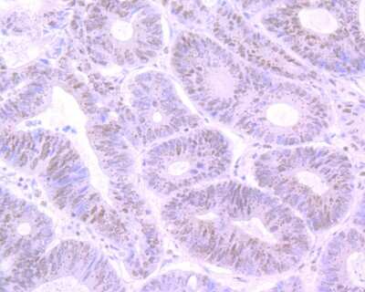 Immunohistochemistry-Paraffin: Cyclin E1 Antibody (SD20-24) [NBP2-67743] - Immunohistochemical analysis of paraffin-embedded human colon carcinoma tissue using anti-Cyclin E1 antibody. The section was pre-treated using heat mediated antigen retrieval with Tris-EDTA buffer (pH 8.0-8.4) for 20 minutes. The tissues were blocked in 5% BSA for 30 minutes at room temperature, washed with ddH2O and PBS, and then probed with the primary antibody (1/50) for 30 minutes at room temperature. The detection was performed using an HRP conjugated compact polymer system. DAB was used as the chromogen. Tissues were counterstained with hematoxylin and mounted with DPX.