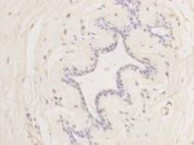 Immunohistochemistry-Paraffin: Cyclin E2 Antibody (40-89) [NBP2-67012] - Analysis of paraffin- embedded human breast carcinoma tissue using anti- Cycliin E2 Mouse mAb.