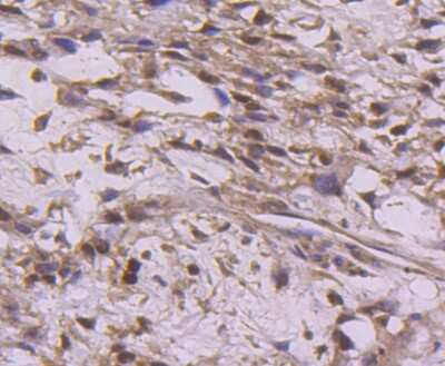 Immunohistochemistry-Paraffin: Cyclin E2 Antibody (SD2035) [NBP2-67744] - Analysis of paraffin-embedded human breast carcinoma tissue using anti-Cyclin E2 antibody. Counter stained with hematoxylin.