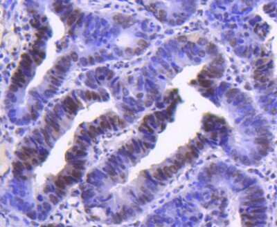 Immunohistochemistry-Paraffin: Cyclin H Antibody (SN20-48) [NBP2-67719] - Analysis of paraffin-embedded human colon cancer tissue using anti-Cyclin H antibody. Counter stained with hematoxylin.