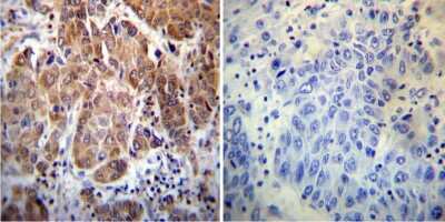 Immunohistochemistry-Paraffin: Cyclophilin 40 Antibody [NB120-3562] - Both normal and cancer biopsies of deparaffinized human Hepatocarcinoma tissue.