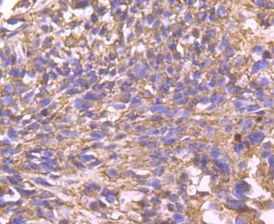 Immunohistochemistry-Paraffin: Cyclophilin-F Antibody (JM71-39) [NBP2-67014] - Analysis of paraffin-embedded human breast cancer tissue using anti-Cyclophilin F antibody. Counter stained with hematoxylin.