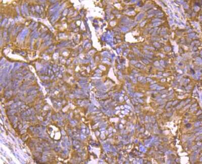 Immunohistochemistry-Paraffin: Cyclophilin-F Antibody (JM71-39) [NBP2-67014] - Analysis of paraffin-embedded human colon cancer tissue using anti-Cyclophilin F antibody. Counter stained with hematoxylin.