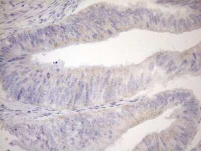 Immunohistochemistry: Cyclophilin-F Antibody (OTI1G8) - Azide and BSA Free [NBP2-71551] - Analysis of Adenocarcinoma of Human colon tissue using PPIF mouse monoclonal antibody. (Heat-induced epitope retrieval by 1mM EDTA in 10mM Tris buffer (pH8.5) at 120C for 3 min)