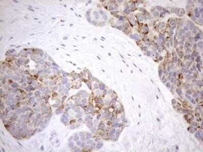 Immunohistochemistry: Cyclophilin-F Antibody (OTI1G8) - Azide and BSA Free [NBP2-71551] - Analysis of Adenocarcinoma of Human endometrium tissue using PPIF mouse monoclonal antibody.(Heat-induced epitope retrieval by 1mM EDTA in 10mM Tris buffer (pH8.5) at 120C for 3 min)