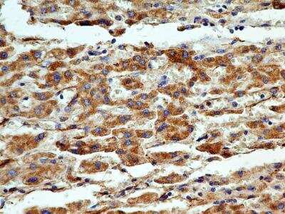 Immunohistochemistry-Paraffin: Cyr61/CCN1 Antibody (3A7.1B8) [NBP2-36490] - IHC analysis of formalin-fixed paraffin-embedded tissue section of human hepatocellular carcinoma using Cyr61/CCN1 antibody (clone 3A7.1B8) at 5 ug/ml concentration. The cancer cells generated a specific cytoplasmic staining with some staining in the inter-cellular spaces but no signal in the cellular nuclei, tumor stroma or the RBCs.