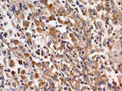 Immunohistochemistry-Paraffin: Cyr61/CCN1 Antibody (3A7.1B8) [NBP2-36490] - IHC analysis of formalin-fixed paraffin-embedded tissue section of human Renal Cell Carcinoma using Cyr61/CCN1 antibody (clone 3A7.1B8) at 5 ug/ml concentration. The cancer cells generated a specific cytoplasmic staining with some staining in the inter-cellular spaces but no signal in the cellular nuclei, tumor stroma or the RBCs.