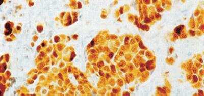 Immunohistochemistry: Cystatin A Antibody (WR 23/2/3/3) [NBP2-88987] - Immunostaining with MAb to cystatin A in infiltrative breast carcinoma.