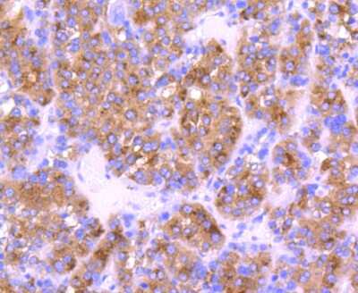Immunohistochemistry-Paraffin: Cystatin C Antibody (JJ09-16) [NBP2-67898] - Analysis of paraffin-embedded human liver cancer tissue using anti-Cystatin C antibody. Counter stained with hematoxylin.