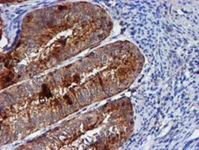 Immunohistochemistry: Cystatin C Antibody (OTI2C8) - Azide and BSA Free [NBP2-70472] - Staining of paraffin-embedded Adenocarcinoma of Human endometrium tissue using anti-Cystatin C mouse monoclonal antibody.