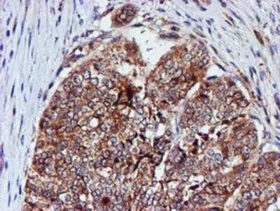 Immunohistochemistry: Cystatin C Antibody (OTI2C8) - Azide and BSA Free [NBP2-70472] - Staining of paraffin-embedded Adenocarcinoma of Human ovary tissue using anti-Cystatin C mouse monoclonal antibody.