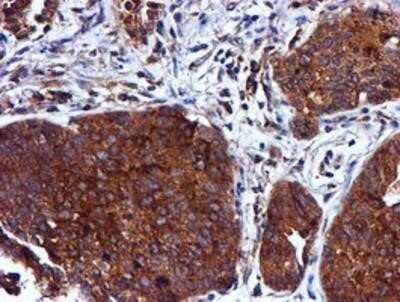 Immunohistochemistry: Cystatin C Antibody (OTI2C8) - Azide and BSA Free [NBP2-70472] - Staining of paraffin-embedded Carcinoma of Human lung tissue using anti-Cystatin C mouse monoclonal antibody.