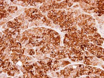 Immunohistochemistry-Paraffin: Cystatin S Antibody [NBP1-32996] - SW480 xenograft, using Cystatin S antibody at 1:100 dilution. Antigen Retrieval: Trilogy™ (EDTA based, pH 8.0) buffer, 15min