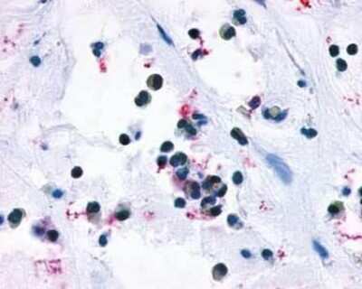 Immunohistochemistry-Paraffin: Cysteinyl Leukotriene R1/CysLTR1 Antibody [NLS1317] - Analysis of anti-CYSLTR1 / CYSLT1 antibody with human nasal mucosa, allergic rhinitis, eosinophils.