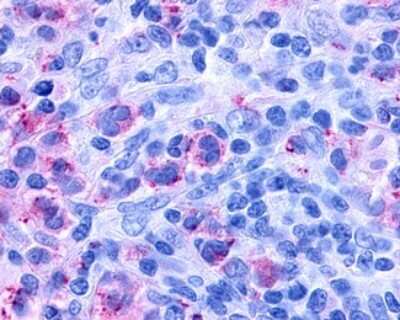 Immunohistochemistry-Paraffin: Cysteinyl Leukotriene R1/CysLTR1 Antibody [NLS1317] - Analysis of anti-CYSLTR1 / CYSLT1 antibody with human lymph node, Hodgkins lymphoma.