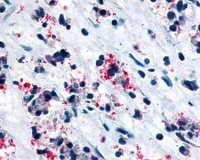 Immunohistochemistry-Paraffin: Cysteinyl Leukotriene R1/CysLTR1 Antibody [NLS1320] - Staining of human nasal mucosa, allergic rhinitis, eosinophils after heat-induced antigen retrieval.