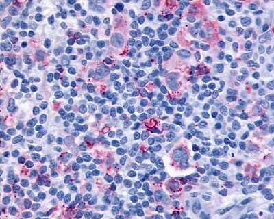 Immunohistochemistry-Paraffin: Cysteinyl Leukotriene R1/CysLTR1 Antibody [NLS1320] - Analysis of anti-CYSLTR1 / CYSLT1 antibody with human lymph node, Hodgkins lymphoma.