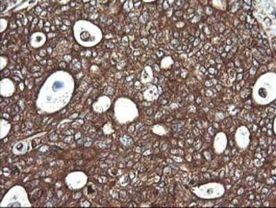 Immunohistochemistry: Cytochrome C Oxidase subunit 6c Antibody (OTI4B11) - Azide and BSA Free [NBP2-70430] - Analysis of Adenocarcinoma of Human breast tissue. (Heat-induced epitope retrieval by 10mM citric buffer, pH6.0, 120C for 3min)