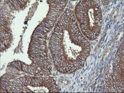 Immunohistochemistry: Cytochrome C Oxidase subunit 6c Antibody (OTI4B11) - Azide and BSA Free [NBP2-70430] - Analysis of Adenocarcinoma of Human endometrium tissue. (Heat-induced epitope retrieval by 10mM citric buffer, pH6.0, 120C for 3min)