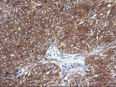 Immunohistochemistry: Cytochrome C Oxidase subunit 6c Antibody (OTI4B11) - Azide and BSA Free [NBP2-70430] - Analysis of Adenocarcinoma of Human ovary tissue. (Heat-induced epitope retrieval by 10mM citric buffer, pH6.0, 120C for 3min)