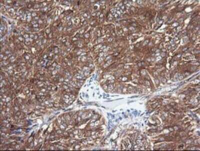 Immunohistochemistry: Cytochrome C Oxidase subunit 6c Antibody (OTI4B11) [NBP2-45645] - Analysis of Adenocarcinoma of Human ovary tissue. (Heat-induced epitope retrieval by 10mM citric buffer, pH6.0, 120C for 3min)