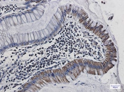 Immunohistochemistry-Paraffin: Cytochrome C Oxidase subunit 6c Antibody (S06-1D9) [NBP3-19951] - Immunohistochemistry of Cytochrome C Oxidase subunit 6c in paraffin-embedded Human colon cancer tissue using NBP3-19951 at dilution 1/20