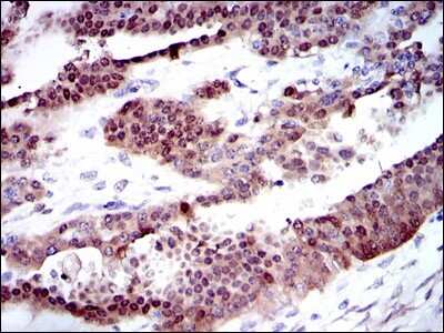 Immunohistochemistry-Paraffin: Cytochrome P450 1A1 Antibody (6G5) [NBP2-37526] - Analysis of ovarian cancer tissues using CYP1A1 mouse mAb with DAB staining.