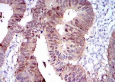 Immunohistochemistry-Paraffin: Cytochrome P450 1A1 Antibody (6G5) [NBP2-37526] - Analysis of rectum cancer tissues using CYP1A1 mouse mAb with DAB staining.