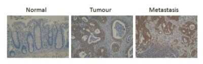 Immunohistochemistry: Cytochrome P450 26B1 Antibody (T5P3G2-A3) [NBP2-50195] - Staining of tissue in normal and two disease states.