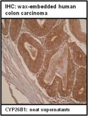 Immunohistochemistry-Paraffin: Cytochrome P450 26B1 Antibody (T5P3G2-A3) [NBP2-50195] - Staining of a colon carcinoma cross section.