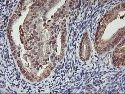 Immunohistochemistry: Cytochrome P450 2A6 Antibody (OTI1D2) - Azide and BSA Free [NBP2-70524] - Staining of paraffin-embedded Adenocarcinoma of Human endometrium tissue using anti-Cytochrome P450 2A6 mouse monoclonal antibody.