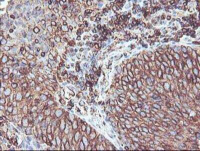 Immunohistochemistry-Paraffin: Cytochrome P450 2B6 Antibody (3D5) [NBP2-01800] - Staining of paraffin-embedded Carcinoma of Human bladder tissue using anti-Cytochrome P450 2B6 mouse monoclonal antibody.