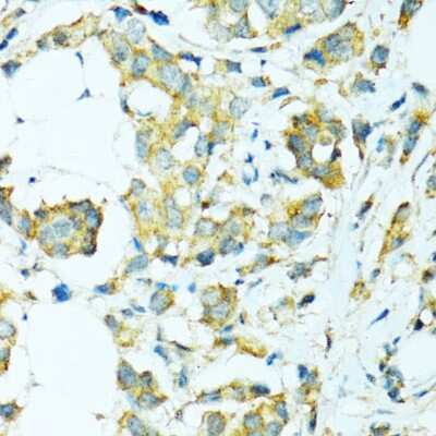 Immunohistochemistry-Paraffin: Cytochrome P450 2B6 Antibody [NBP2-92746] - Paraffin-embedded human breast cancer using Cytochrome P450 2B6 .