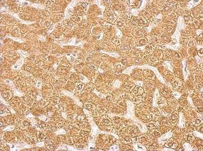 Immunohistochemistry-Paraffin: Cytochrome P450 2C8 Antibody [NBP2-16078] - Antibody detects CYP2C8 protein at cytosol on hepatoma by immunohistochemical analysis. Sample: Paraffin-embedded hepatoma. CYP2C8 antibody dilution: 1:500.