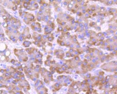 Immunohistochemistry-Paraffin: Cytochrome P450 2E1 Antibody (JM10-85) [NBP2-67021] - Analysis of paraffin-embedded human liver cancer tissue using anti-CYP2E1 antibody. Counter stained with hematoxylin.