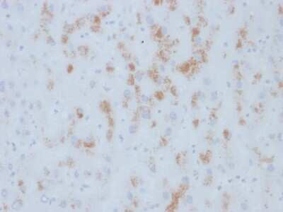 Immunohistochemistry-Paraffin: Cytochrome P450 2E1 Antibody (M12P4H2) - Azide and BSA Free [NBP3-08831] - Formalin-fixed, paraffin-embedded human Hepatic Carcinoma stained with Cytochrome P450 2E1 Mouse Monoclonal Antibody (M12P4H2).