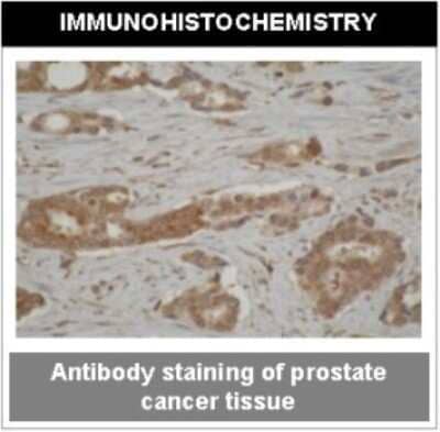 Immunohistochemistry: Cytochrome P450 3A4, 3A5 Antibody (F24P2B10) [NBP2-50208] - Analysis of cytochorme P450 expression in a crossection of prostate cancer tissue.