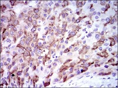 Immunohistochemistry-Paraffin: Cytochrome P450 3A4 Antibody (3H8) [NBP2-37502] - Analysis of liver cancer tissues using CYP3A4 mouse mAb with DAB staining.